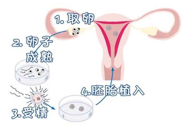 双桥代孕中心哪家较好_马来西亚试管婴儿体外受精详细步骤流程是怎样的？